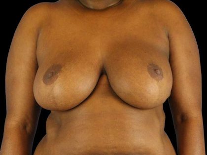 Oncoplastic Reconstruction Before & After Patient #1784