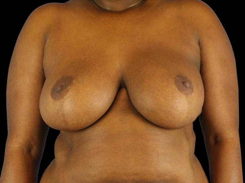 Oncoplastic Reconstruction Before & After Patient #1784