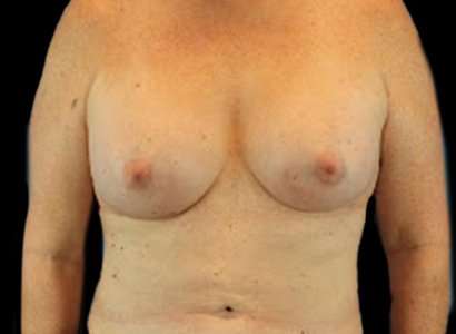 MTF Breast Augmentation Before & After Patient #1802