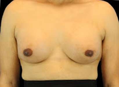 MTF Breast Augmentation Before & After Patient #1809