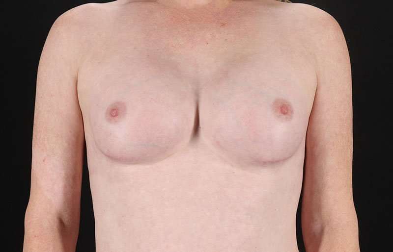 MTF Breast Augmentation Before & After Patient #1820