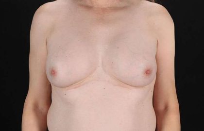 MTF Breast Augmentation Before & After Patient #1831