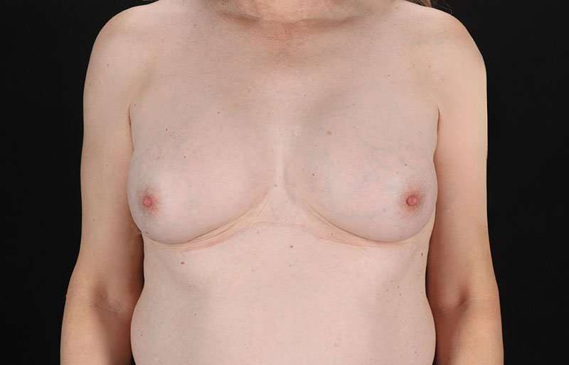 MTF Breast Augmentation Before & After Patient #1831
