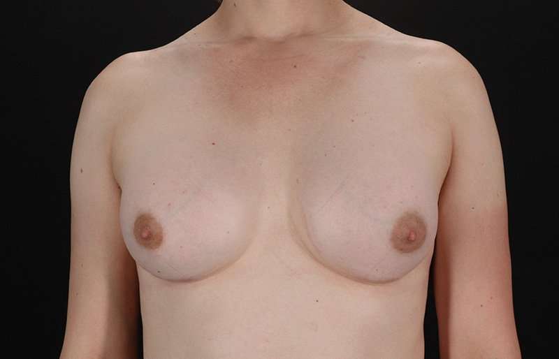 MTF Breast Augmentation Before & After Patient #1842