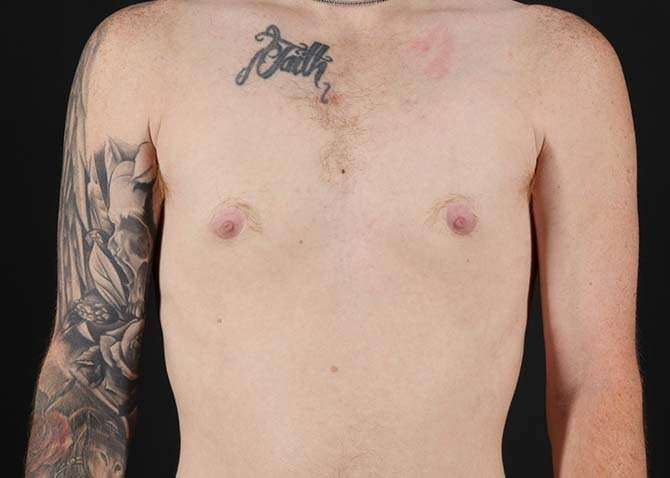 FTM Chest Contouring Before & After Patient #1864