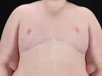 FTM Chest Contouring Before & After Patient #1875