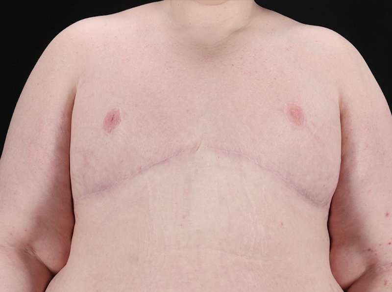 FTM Chest Contouring Before & After Patient #1875