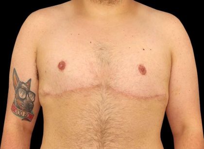 FTM Chest Contouring Before & After Patient #1886