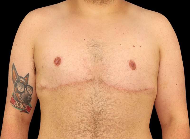 FTM Chest Contouring Before & After Patient #1886