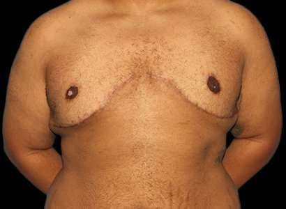 FTM Chest Contouring Before & After Patient #1893