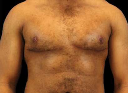 FTM Chest Contouring Before & After Patient #1907