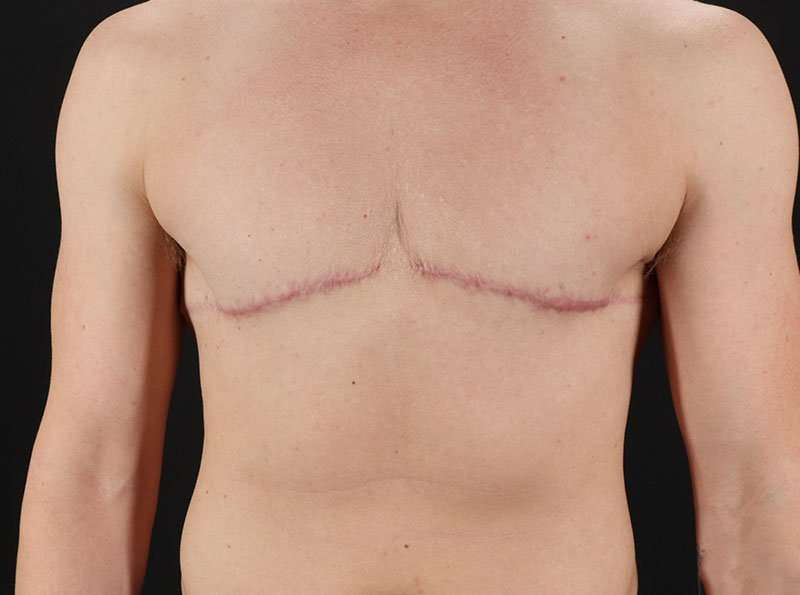 FTM Chest Contouring Before & After Patient #1918