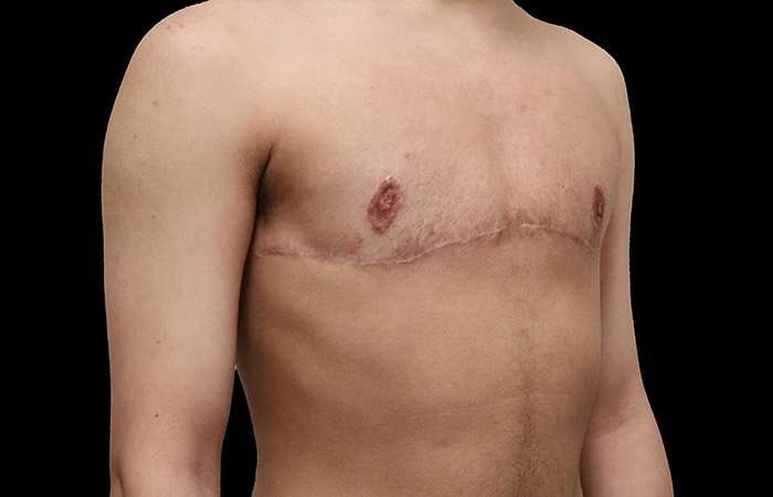 FTM Chest Contouring Before & After Patient #1929