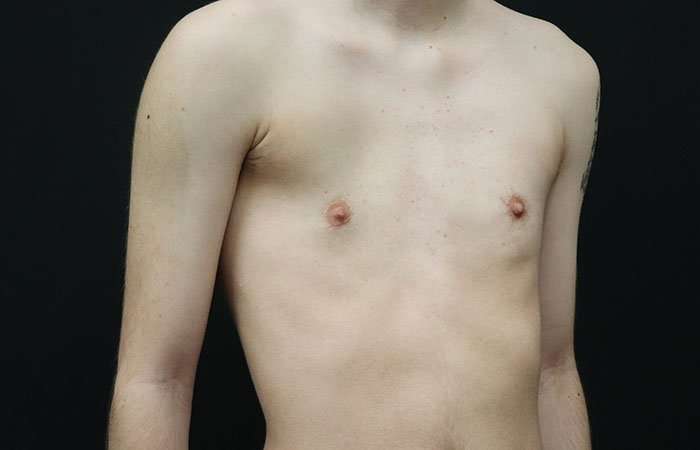 FTM Chest Contouring Before & After Patient #1940