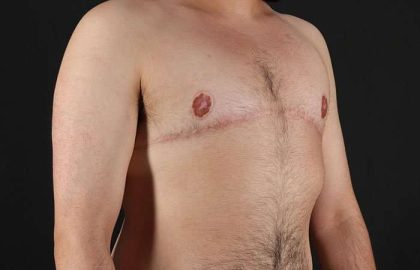 FTM Chest Contouring Before & After Patient #1951