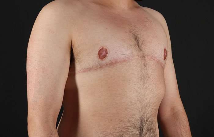 FTM Chest Contouring Before & After Patient #1951