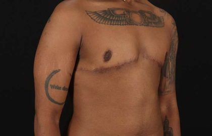 FTM Chest Contouring Before & After Patient #1962