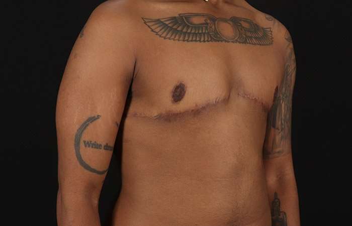 FTM Chest Contouring Before & After Patient #1962