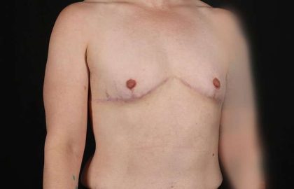 FTM Chest Contouring Before & After Patient #1973