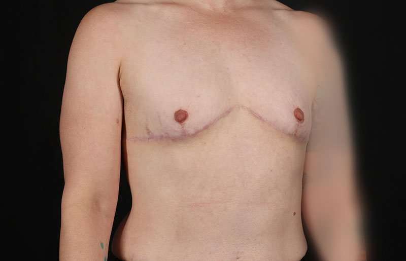 FTM Chest Contouring Before & After Patient #1973