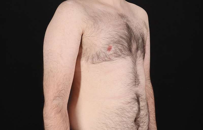 FTM Chest Contouring Before & After Patient #1984