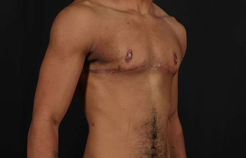 FTM Chest Contouring Before & After Patient #1995