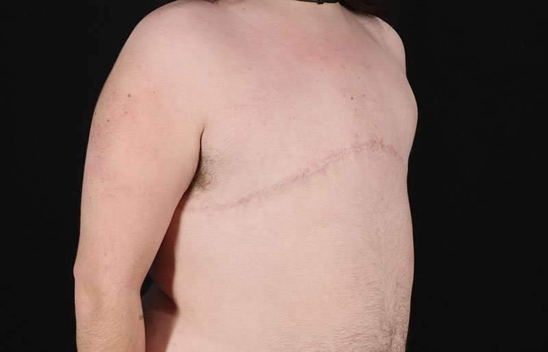 FTM Chest Contouring Before & After Patient #2006