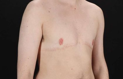 FTM Chest Contouring Before & After Patient #2017