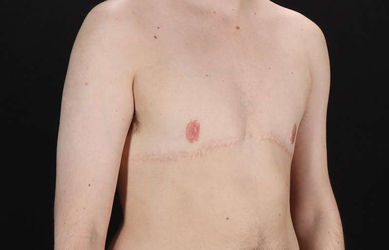 FTM Chest Contouring Before & After Patient #2017