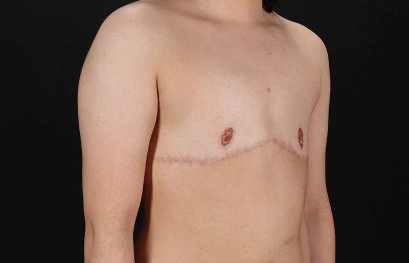 FTM Chest Contouring Before & After Patient #2028