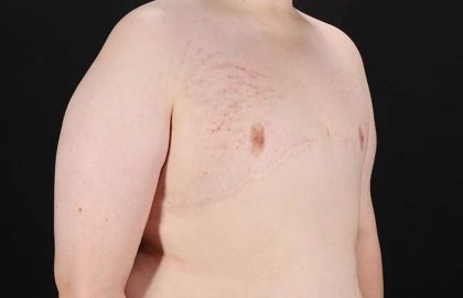 FTM Chest Contouring Before & After Patient #2039