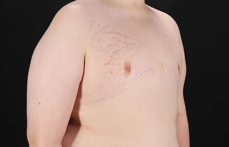 FTM Chest Contouring Before & After Patient #2039