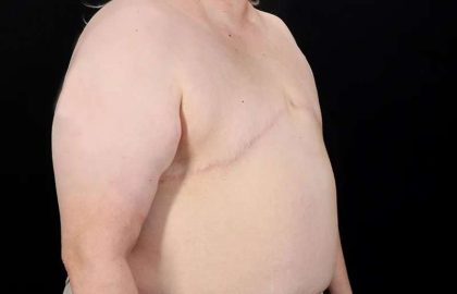 FTM Chest Contouring Before & After Patient #2050