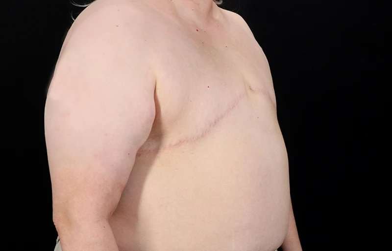 FTM Chest Contouring Before & After Patient #2050