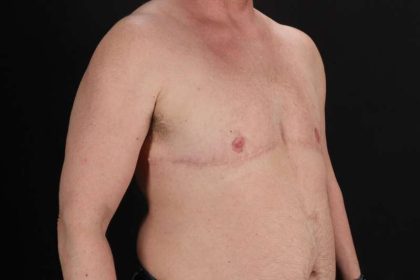 FTM Chest Contouring Before & After Patient #2061