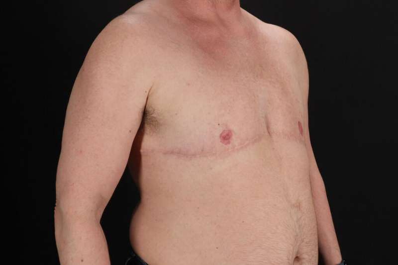 FTM Chest Contouring Before & After Patient #2061