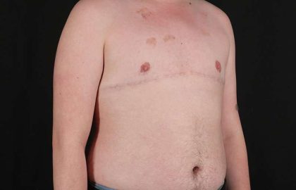 FTM Chest Contouring Before & After Patient #2072