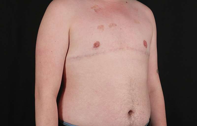 FTM Chest Contouring Before & After Patient #2072