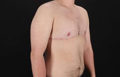 FTM Chest Contouring Before & After Patient #2083