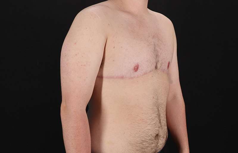 FTM Chest Contouring Before & After Patient #2083