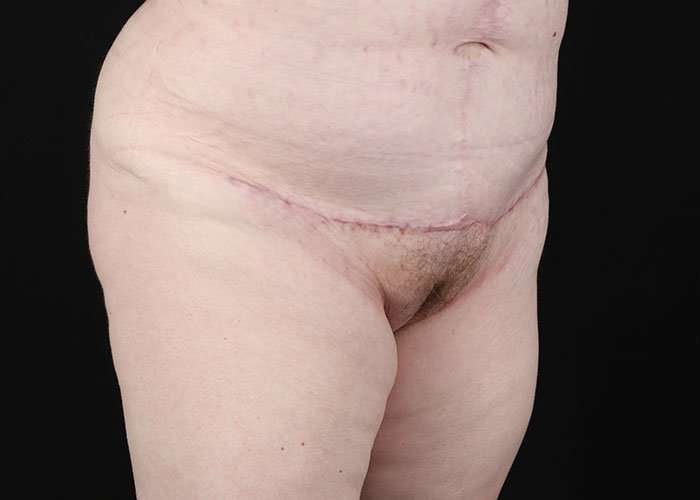 Monsplasty Before & After Patient #2106