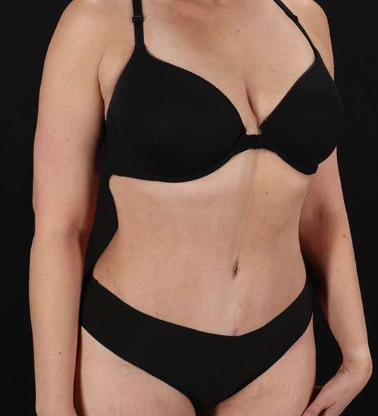 Tummy Tuck Before & After Patient #2128