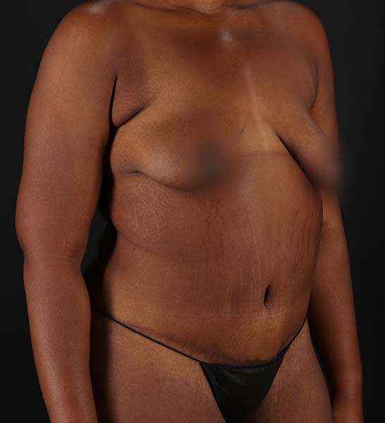 Tummy Tuck Before & After Patient #2139