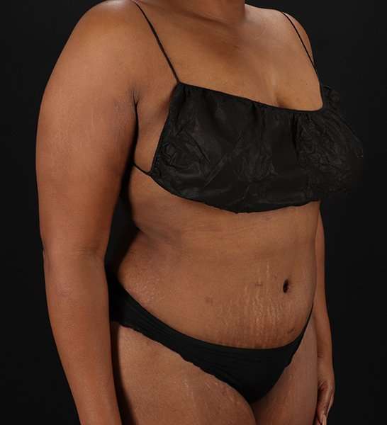 Tummy Tuck Before & After Patient #2146