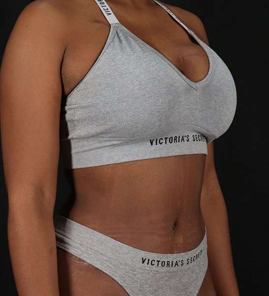 Tummy Tuck Before & After Patient #2168