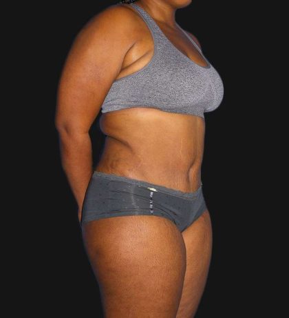 Tummy Tuck Before & After Patient #2179