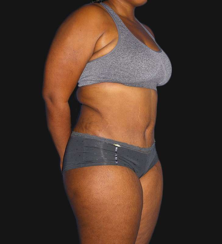 Tummy Tuck Before & After Patient #2179