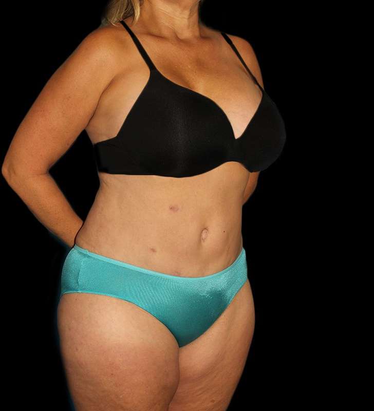 Tummy Tuck Before & After Patient #2190
