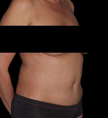Tummy Tuck Before & After Patient #2201
