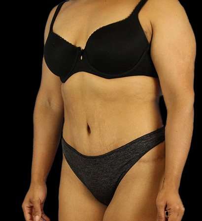 Tummy Tuck Before & After Patient #2212